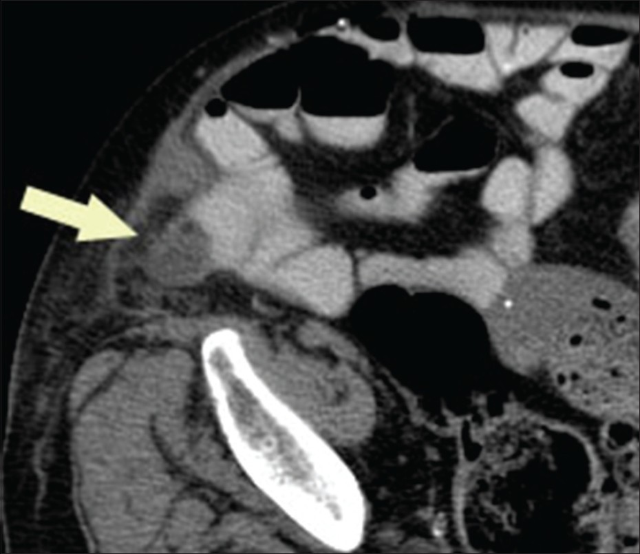 Carcinoma of the appendix. Axial computed tomography image through the right lower quadrant demonstrates a homogenously thickened appendix with minimal surrounding fat stranding (arrow) exerting mass effect upon adjacent contrast-filled small bowel.