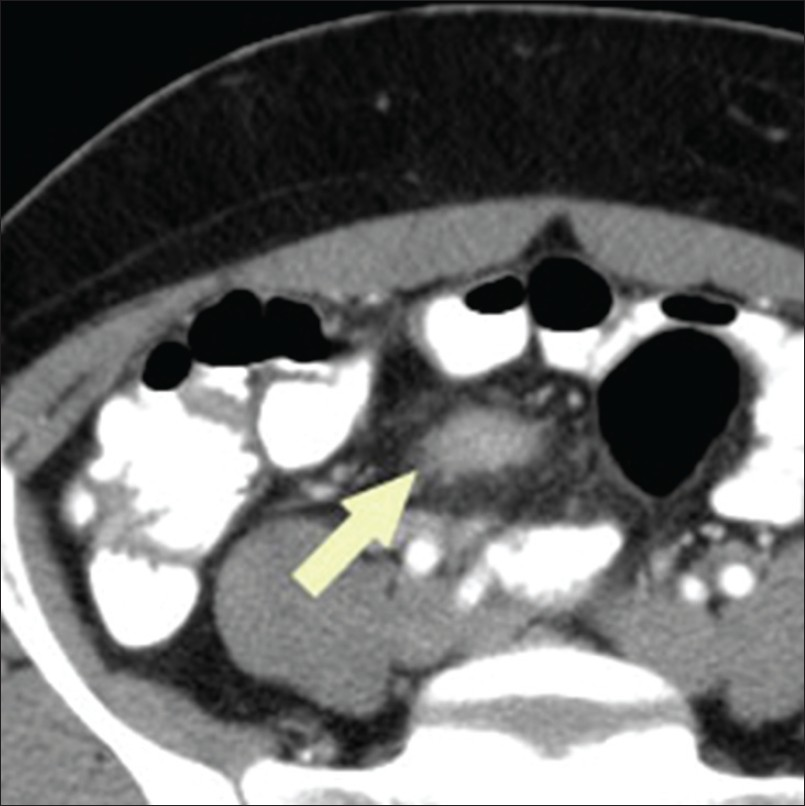Endometriosis involving the appendix. Axial computed tomography image through the upper pelvis shows a thickened appendix with hazy borders (arrow) and surrounding mild infiltrative changes in the mesenteric fat.