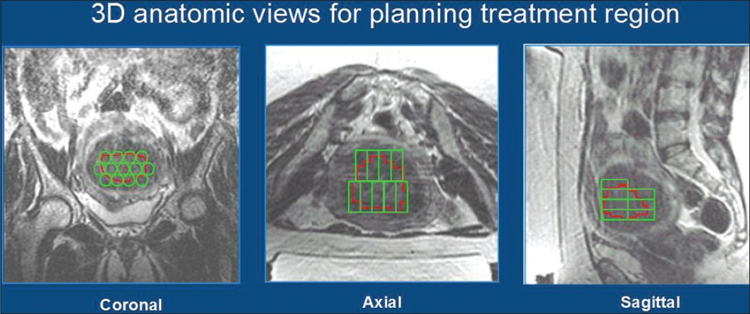 Axial, sagittal, and coronal T2-weighted magnetic resonance (MRI) images of the pelvic region to plan treatment of the fibroids