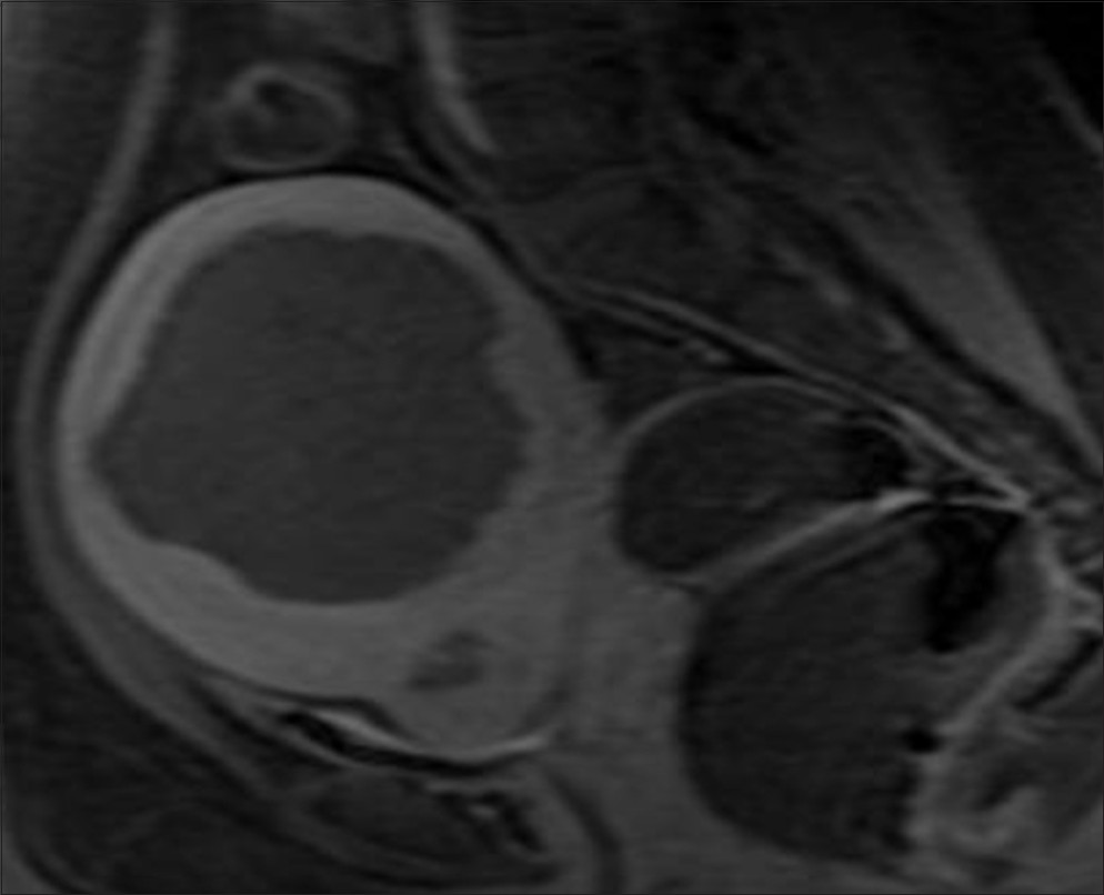 Post-treatment post-contrast T1-weighted magnetic resonance (MRI) images of the pelvic region shows the ablated fibroid (Approximate Fibroid volume 271 cc