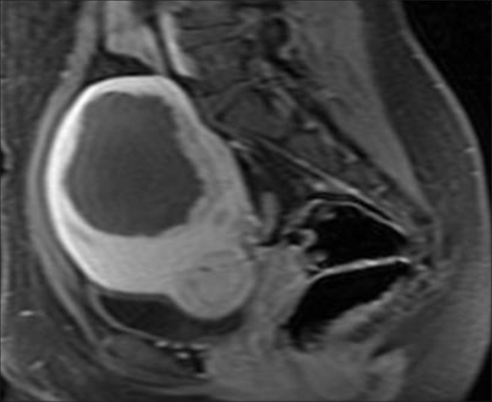 Six-month follow-up post-treatment post-contrast T1-weighted image shows 45-50% reduction in size of ablated fibroid (approximate volume 140 cc)