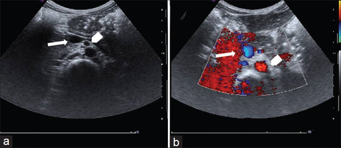 (a) Ultrasound of mid abdomen shows superior mesentery vein (arrow) and superior mesentery artery to the left (b) The doppler flow study confirms arterial flow in the superior mesentery artery (arrowhead) and the venous flow in the uncompressed superior mesenteric vein (arrow).