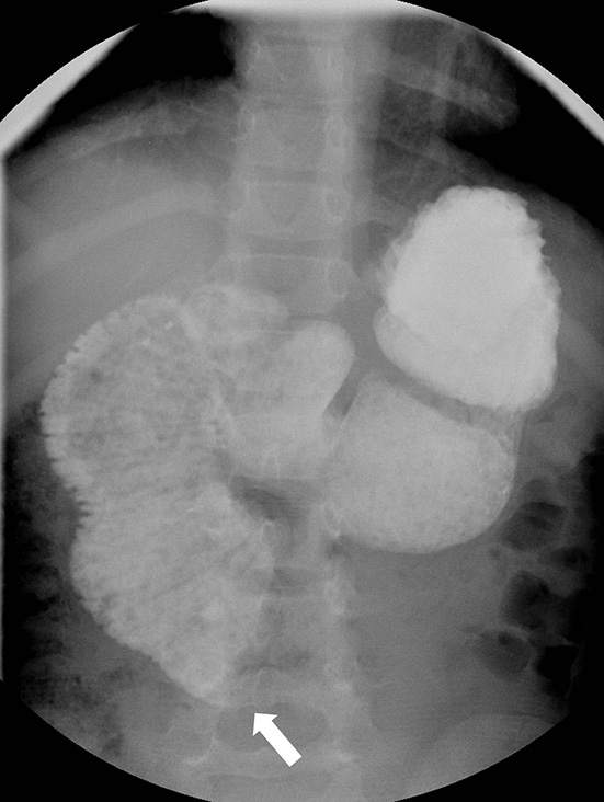 Single contrast upper gastrointestinal series shows on a single view plain radiograph the contrast abruptly cutting off approximately at the mid abdomen (arrow).