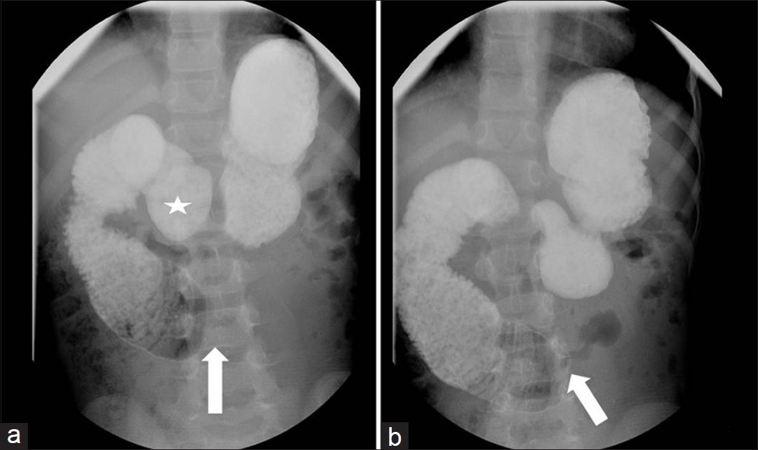 Single contrast upper gastrointestinal series shows on delayed images with patient laying supine, contrast never extending beyond third portion of duodenum with persistent cutoff (arrow). Contrast is seen in antrum of stomach (star), proximal duodenum, and descending duodenum.