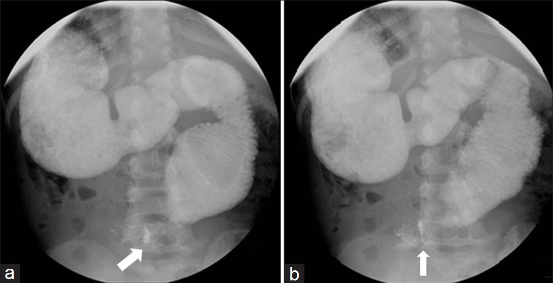 Delayed prone images demonstrated contrast in the proximal small bowel with persistent dilatation of the proximal duodenum.