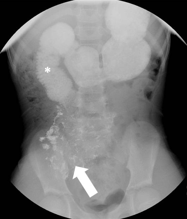 Additional delayed image following several minutes of prone position demonstrates a small amount of contrast progressing to the jejunum (arrow). There is persistent dilatation of the proximal duodenum (asterisk).