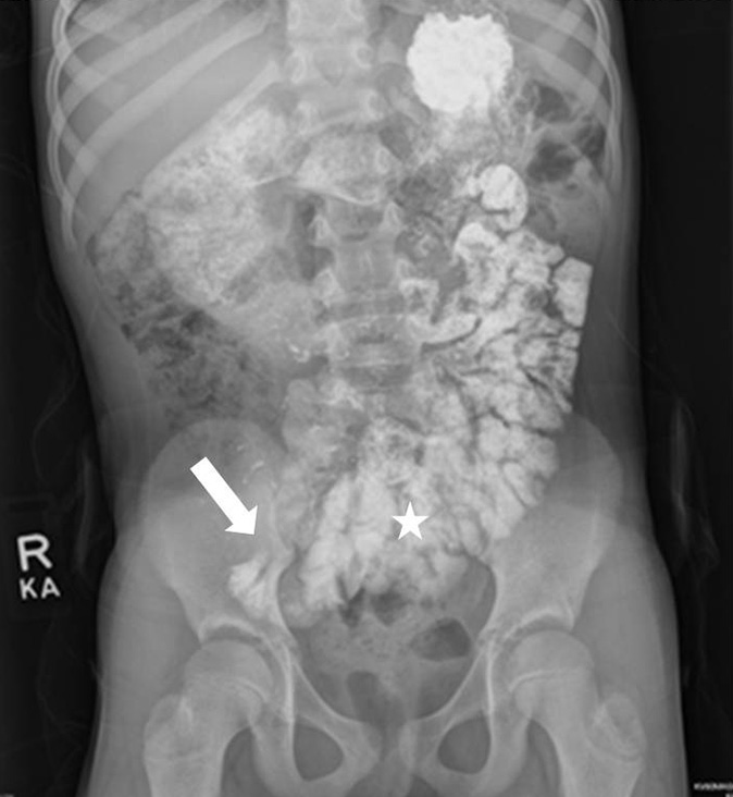 Delayed abdominal radiograph following the upper gastrointestinal series after patient had been upright for greater than 30mins demonstrates further progression of contrast into the jejunum and ileum (star). Distal most extent of contrast near the cecum (arrow).