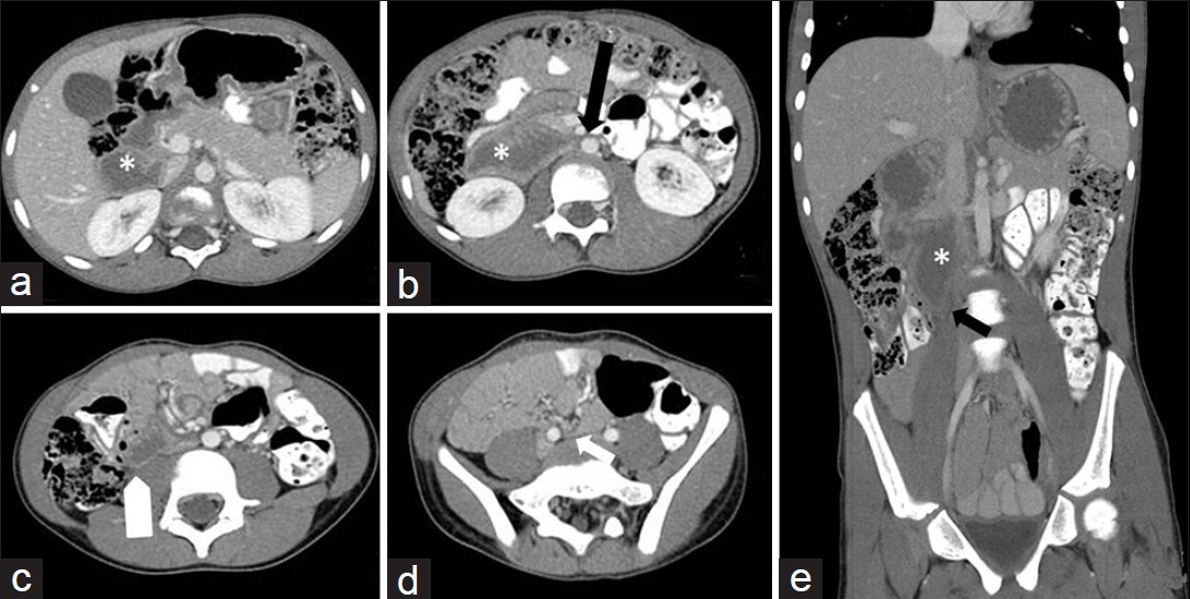 Computed tomography (CT) of the abdomen and pelvis shows dilated fluid filled duodenum (asterisk, a). Duodenum tented medially (black arrow, b) and downward (white arrow, c, black arrow, e). Duodenum severely narrowed as it crosses anterior to right femoral vein below the bifurcation (white arrow, d).