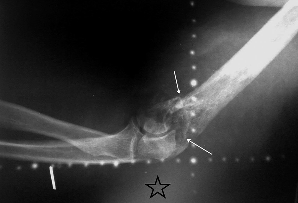 Plain radiograph before initiation of radiotherapy shows an irregular and poorly defined destructive lytic lesion with no periosteal reaction in distal humerus associated with pathologic fracture (white arrows) and abnormal adjacent soft tissue density (star).