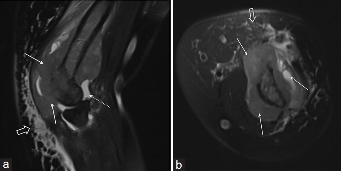 (a) Sagittal and (b) Axial fat suppressed T2-weighted images demonstrate soft tissue mass (white arrows) surrounding the left humerus with destruction of bone cortex and replacement of the involved bone marrow with non-homogenous intermediate signal intensity compared to adjacent bone marrow. Also noted are joint effusion (dashed arrows) accompanied by subcutaneous edema (open arrows).