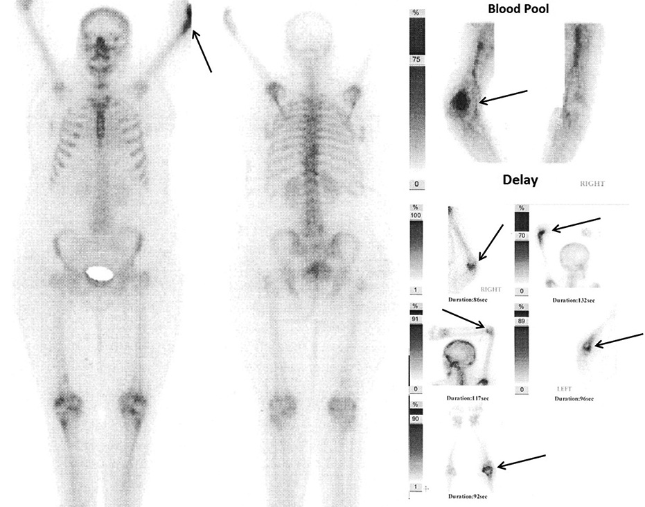 Tc99 MDP isotopic bone scan demonstrates isolated increased tracer concentration at the distal of left humerus (arrows) which is also persistent in delayed images (right lower corner). Scintigraphic evidence of skeletal metastasis was not found elsewhere.