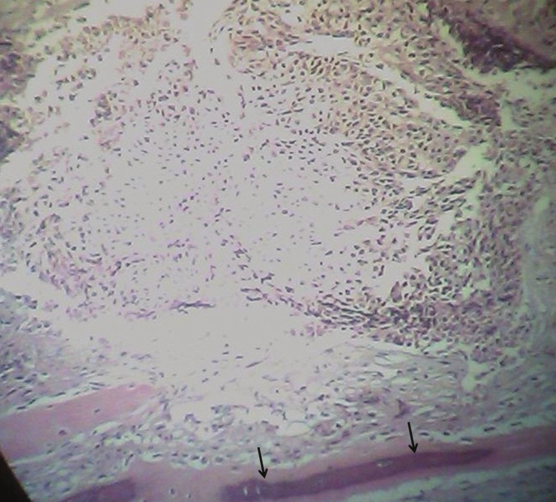 Section shows a neoplasm composed of pleomorphic, large nonkeratinizing and high nucleus to cytoplasm ratio cells with marked nucleoli arranged in sheet formations which infiltrate soft tissue and bony trabeculi (arrows). Also noted are some foci of necrosis. These findings are consistent with poorly differentiated metastatic squamous cell carcinoma.