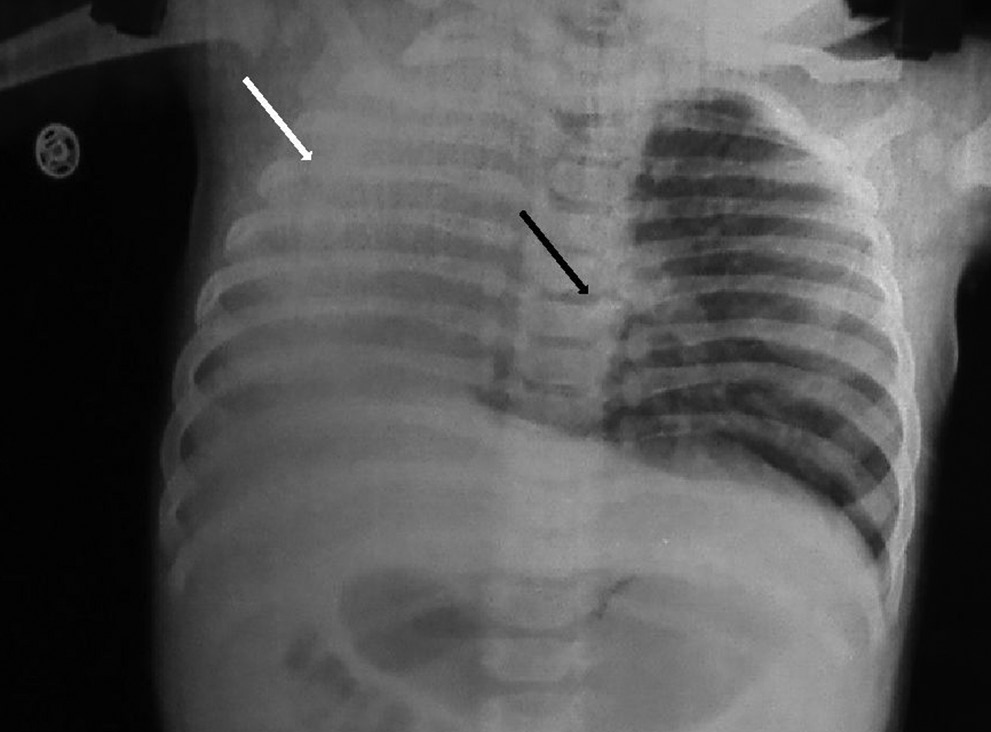 Chest X-ray of 4-month old boy shows homogenous opacity (white arrow) on the rightside with mediastinal shift and herniation of left lung (black arrow).