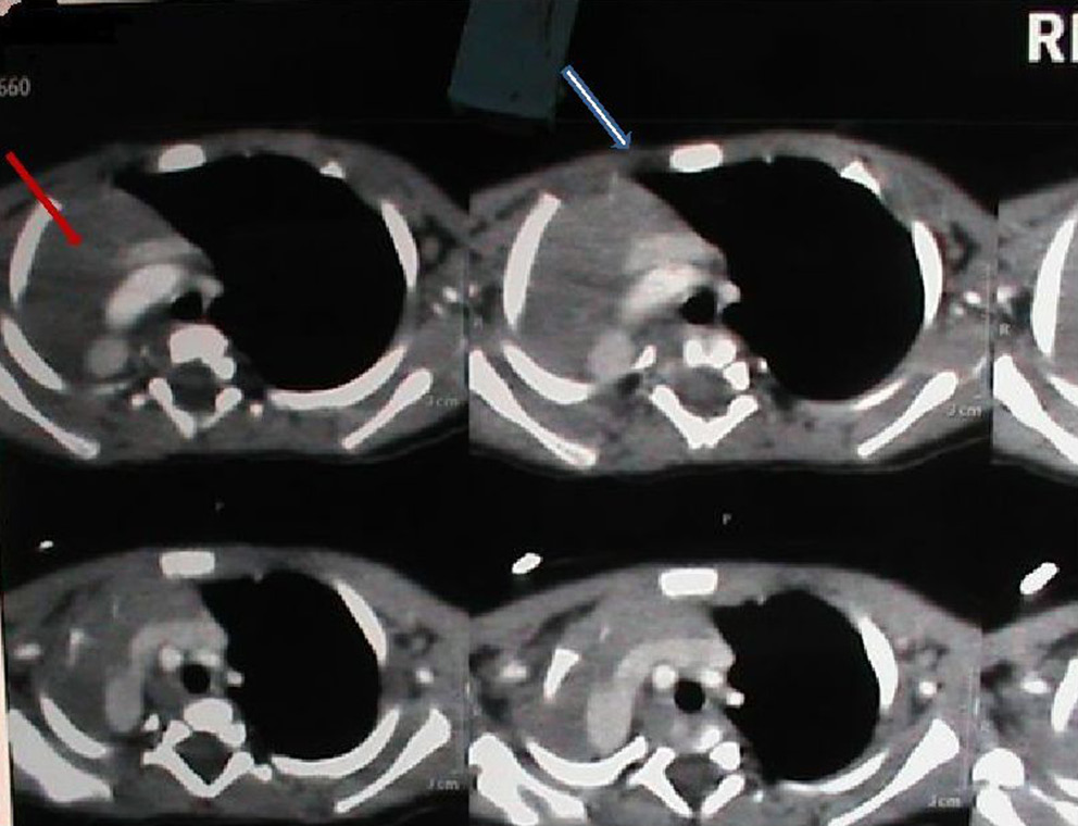 Contrast enhanced computed tomography of chest of 4-month-old boy shows absent pulmonary parenchyma on right side (agenesis of the right lung) (arrow) with herniation of left lung. Right hemithorax is occupied by the hear (arrow).