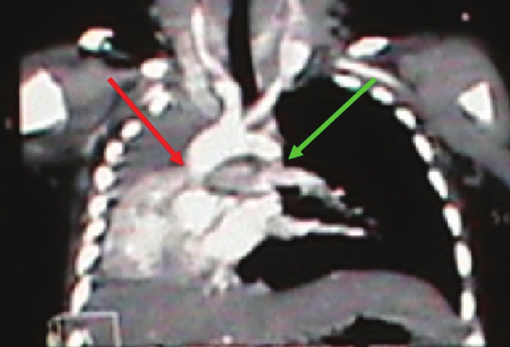 Computed tomography angiography of the 4-month-old child with right lung agenesis shows dextrocardia with absent right pulmonary artery (red arrow) and normal left pulmonary artery (green arrow).