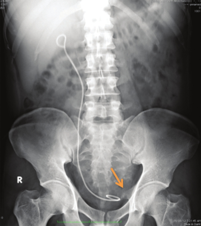 X-ray of the kidney and urinary bladder shows calcific specks (arrow) in the left hemipelvis with Double J stent on the right side.