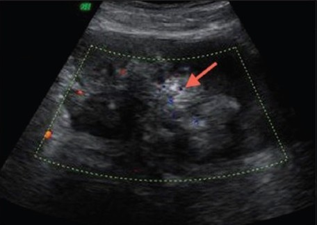 Transverse ultrasound of the pelvis reveals a polypoidal mass in the urinary bladder with calcific specks (arrow).