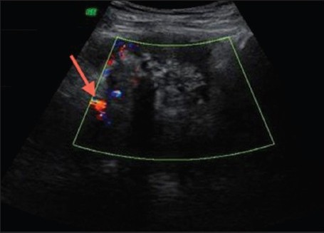 Transverse ultrasound of the pelvis shows a polypoidal mass in the urinary bladder with vascularity (arrow) on color Doppler.