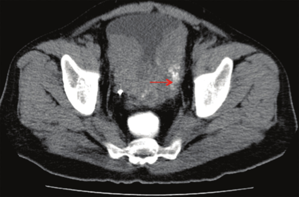 Plain computed tomography of the pelvis shows polypoidal mass within the urinary bladder with dense foci of calcification on the left side (arrow).