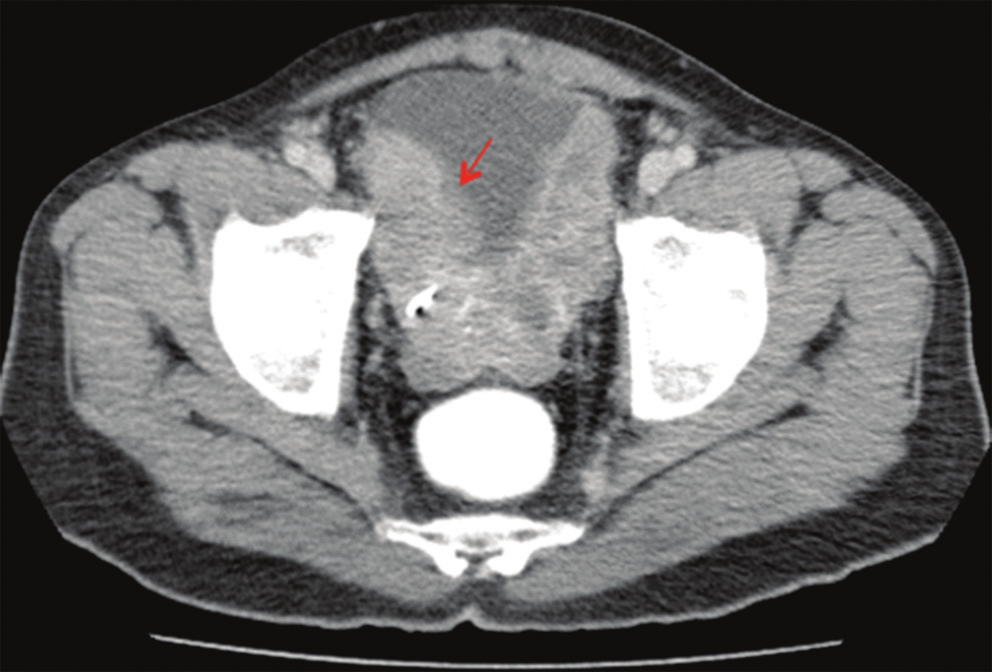 Contrast-enhanced computed tomography of the pelvis shows a heterogenously enhancing polypoidal mass involving the bilateral lateral and posterior walls.