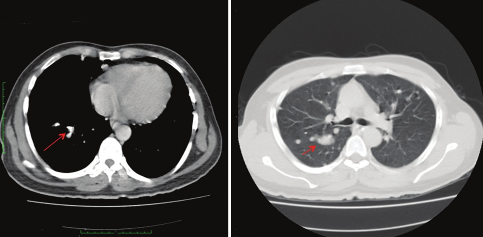 Computed tomography scan of the chest shows multiple well-defined pulmonary nodules in bilateral lung parenchyma (lung window) with specks of calcification in few nodules (mediastinum window).