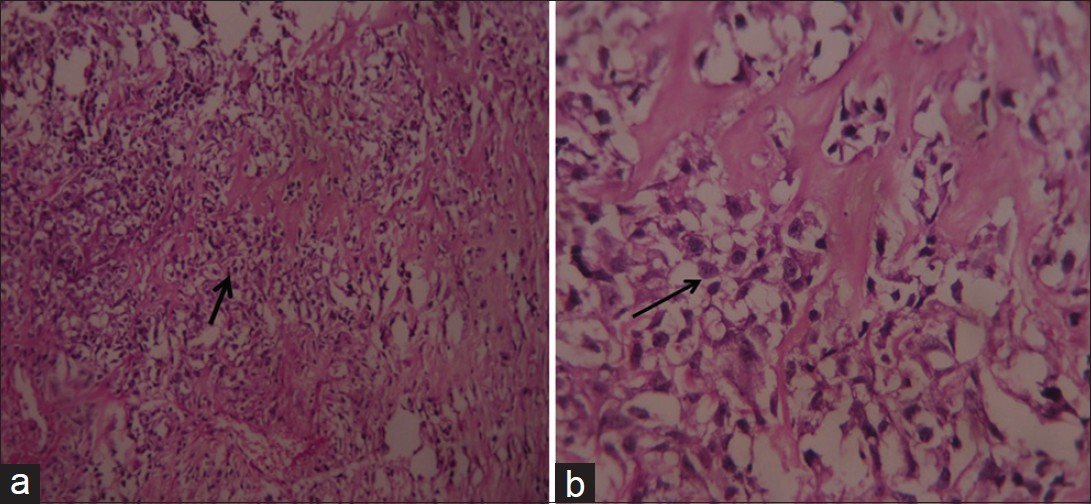 Hematoxylin and eosin-stained specimen (a) at ×20, (b) at ×40, show tumor cells arranged singly and in small nests, embedded in a lace-like malignant osteoid matrix.