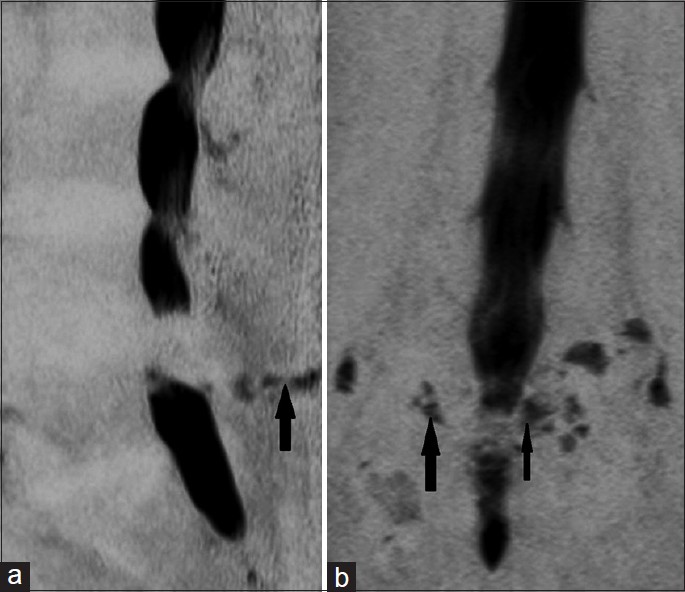 (a, b) Magnetic myelography images in degenerative spine. (a) Sagittal image shows synovial neoarthrosis (black arrow), (b) Coronal image depicts facetic effusion (broad black arrow), Parafacetal cysts(thin black arrow).