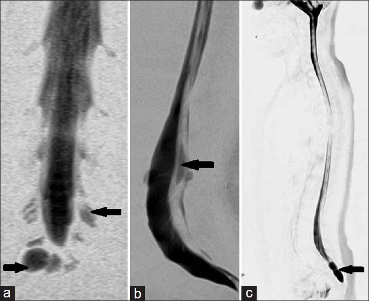 (a-c) Magnetic resonance myelograms in congenital variants/ abnormalities. (a) Coronal image demonstrates conjoined nerve roots (leftsided black arrow), tarlov's cyst (right-sided black arrow), (b) Sagittal image shows syrinx in diastematomyelia (black arrow), and (c) Sagittal image shows incidental occult sacral meningocele (black arrow).