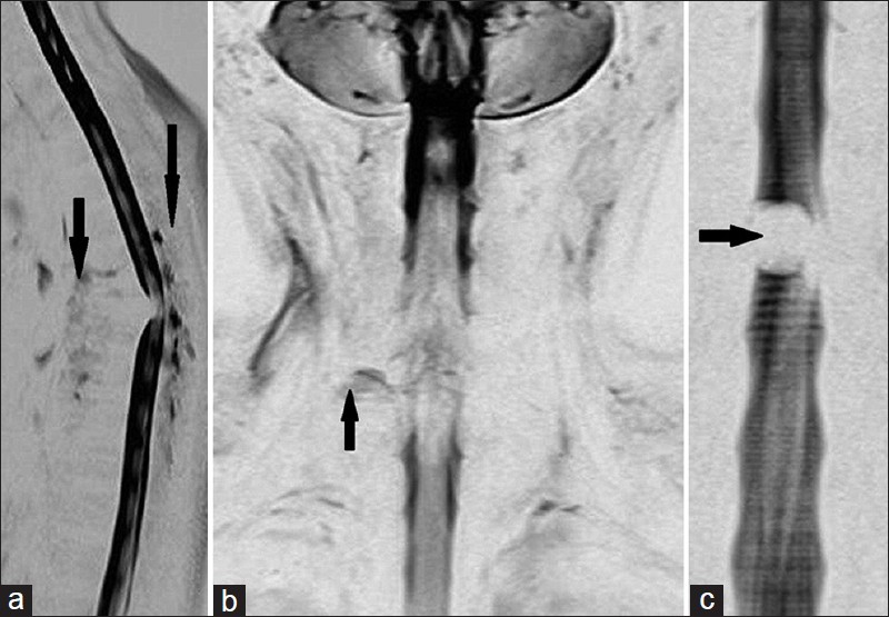 (a-c) (a) Sagittal image shows prevertebral and posterior epidural collection in tuberculous spondylitis, (b) Coronal image reveals pseudomeningocele secondary to nerve root avulsion, and (c) Coronal image demonstrates a well defined intradural filling defect due to meningioma. (Findings marked with black arrows).