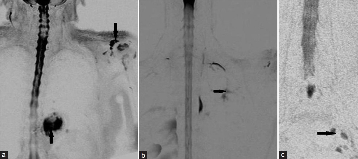 (a-c) Coronal magnetic resonance myelograms depicting various additional extra-spinal findings(black arrows), (a) Diaphragmatic hernia and left glenohumeral joint effusion, (b) Residual apical scar in chronic pulmonary tuberculosis, and (c) Small left-sided iliac lymph nodes.