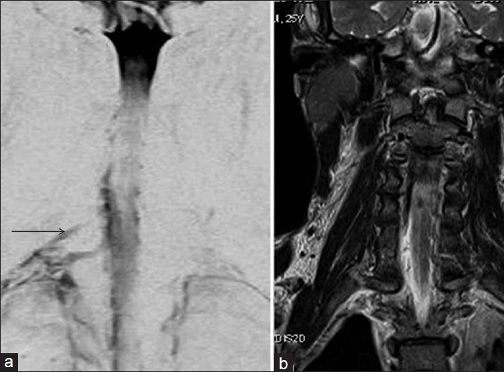 a) Coronal magnetic resonance myelogram clearly shows nerve root avulsion (black arrow) compared to b) routine coronal T2 sequence scan.