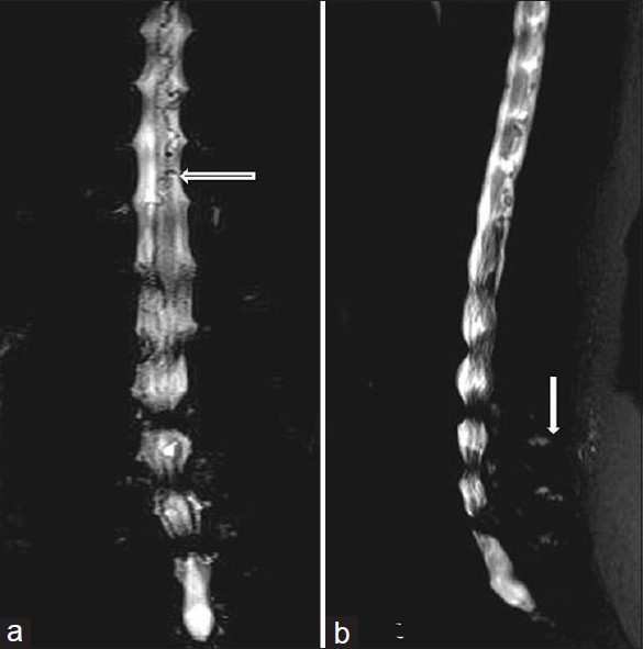 a) Coronal and b) sagittal single thick-slice magnetic resonance myelograms show simultaneous first look detection of significant lumbar canal stenosis, spinal arterio-venous malformation (a) and synovial neoarthrosis (b). (Findings marked with white arrows).