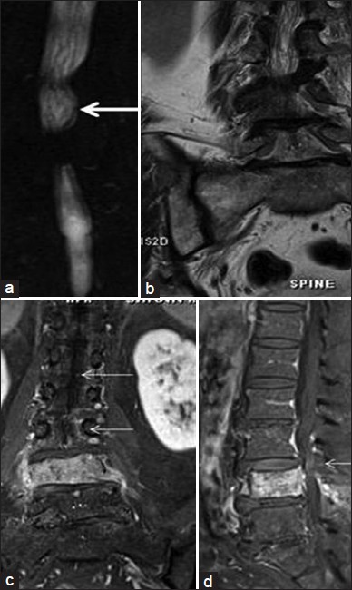 Spinal intradural metastatic deposits. a) Coronal magnetic resonance myelographyshows thickening and nodularity of cauda equina nerve roots (white arrow) which on b) coronal T2 sequence is not discernable. Post-contrast fat-suppressed T1 sequence c) Coronal and d) Sagittal views show nodular enhancement along cauda equina nerve roots on reevaluation (white arrows).