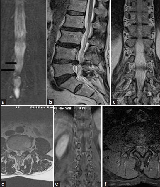 (a-f) Post-operative case of lumbar disc herniation. a) Coronal magnetic resonance myelogram depicts focal asymmetrical irregularity of margin of thecal sac on right side with root sleeve blunting and subtle thickening of cauda equina nerve roots cranially (black arrows). Routine T2 images b) sagittal, c) coronal, d) axial views the findings are difficult to delineate. On post-contrast fatsuppressed T1 sequence e) coronal, f) axial no abnormal enhancement is seen.