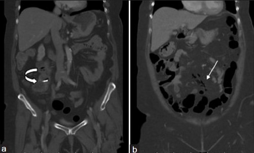 (a and b) Contrast-enhanced coronal CT images (lung window) demonstrate linear pockets of air tracking within small mesenteric veins (white arrow). Note the enteroscopically placed clip in the patient's distal ileal GIST, which was tattooed for the surgeon (curved arrow).