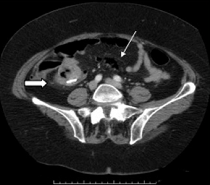 Contrast-enhanced axial CT image demonstrates linear branching pattern of air in the mesenteric veins due to air embolism (white arrow). Note the mild mesenteric stranding around the lesion, a common finding after enteroscopic procedure (thick arrow).