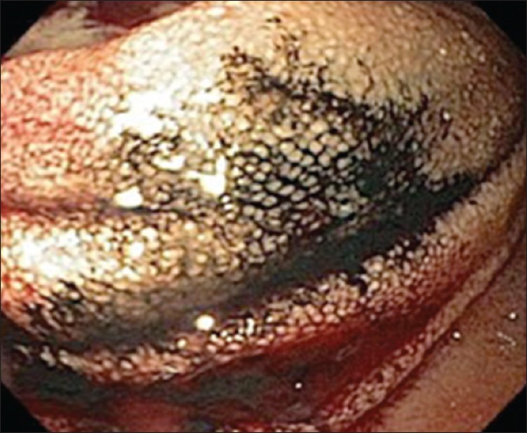 Mucosal surface of enteroscopically tattooed small bowel tumor with India ink. Note the bluish-black appearance of the deposited India ink