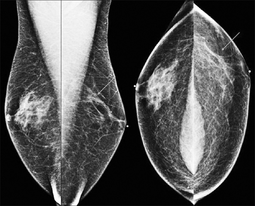 Medial lateral oblique and craniocaudal views of the bilateral breasts show flame-shaped gynecomastia of the right breast. The left breast shows microcalcifcations (arrows) for which magnification views have been performed.