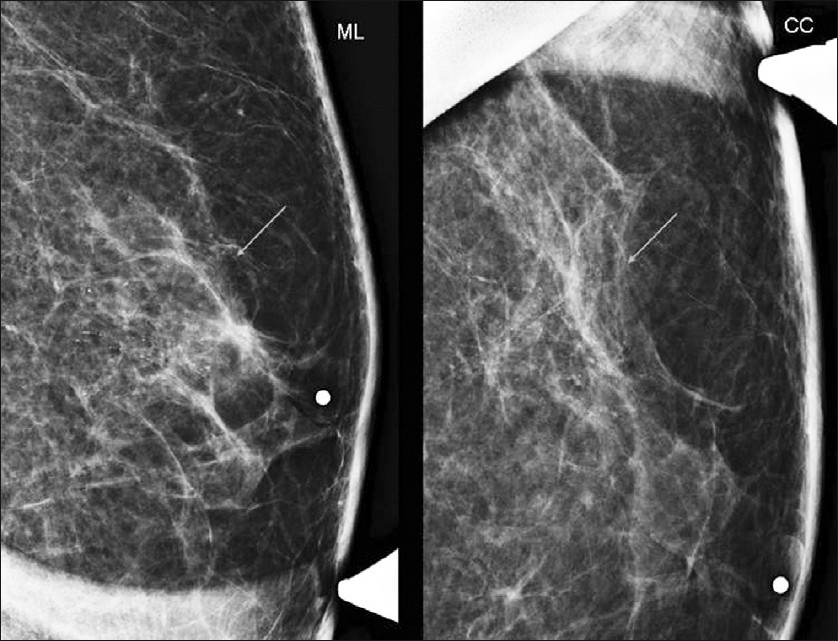 Medial lateral and craniocaudal magnification views of the left breast show suspicious microcalcifications in the retroareolar region extending to the upper outer quadrant (arrows).