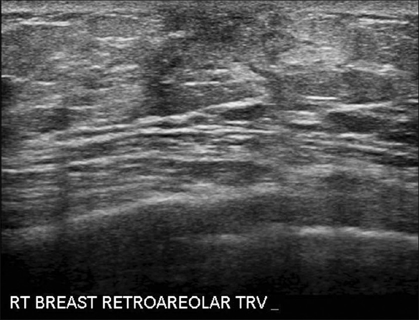 Transverse ultrasound image of the right breast demonstrating retroareolar glandular tissue consistent with gynecomastia. No suspicious masses were identified in the right breast.