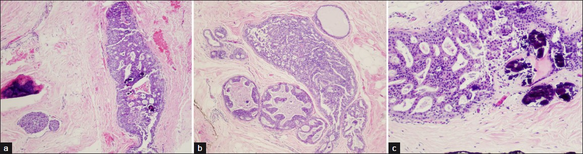 Microscopic findings. (a) Ductal carcinoma in situ with intraductal proliferation of small, monomorphic cells, forming secondary microlumina, with clustered microcalcifications (hematoxylin and eosin stain) (4×). (b) Punctate necrosis is present in some involved ducts (hematoxylin and eosin stain) (4×). (c) Microcalcifications are present within the ducts and stroma (hematoxylin and eosin stain) (10×).