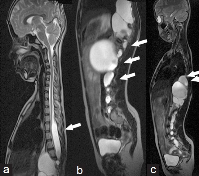Serial sagittal magnetic resonance imaging T2W images of dorso-lumbo-sacral spine. (a) Right parasagittal section. (b) Sagittal section and (c) Left parasagittal section show multiple level and extensive lateral meningocoele with neural foraminal widening (arrow) and dural ectasia (arrow).