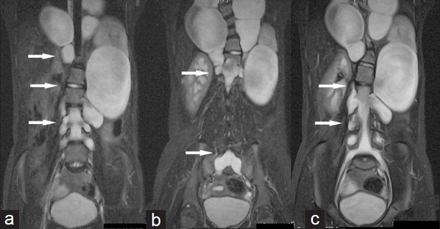 Serial coronal magnetic resonance imaging STIR images (a, b, c) of dorso-lumbo-sacral spine show multiple level and extensive lateral meningocoele with neural foraminal widening (arrow), dural ectasia (arrow) and scoliosis deformity.