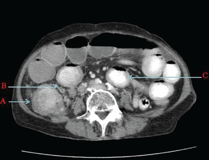 Contrast enhanced computed tomography of abdomen and pelvis (axial section) shows A. Enhancing Intraluminal caecal mass with caecal wall thickening. B. Adjacent necrotic mesentric nodes and C. Dilated small bowel loops with few of them having thickened walls.