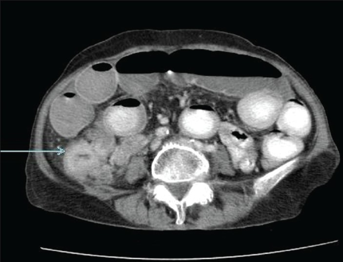 Contrast enhanced computed tomography of abdomen and pelvis (axial section) reveals thickened ileum loop extending into the cecum (arrow).