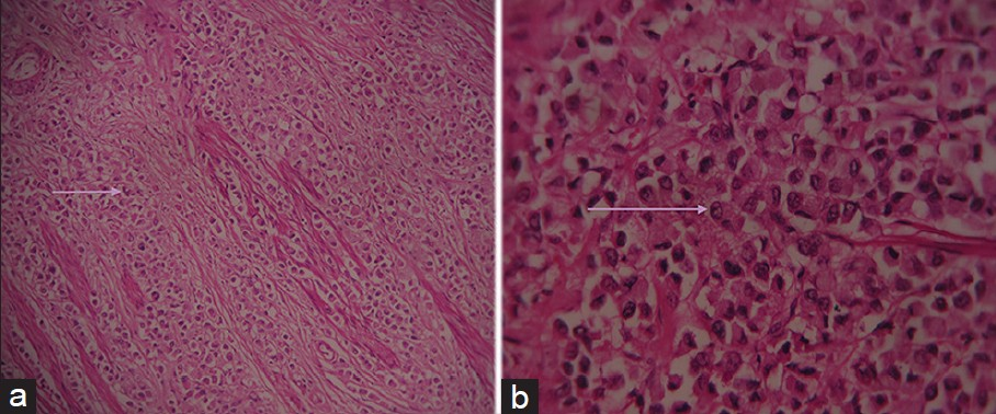 Hematoxylin and eosin stained sample (a) at ×10 and (b) at ×40 demonstrate large monomorphic tumor cells having large round cell nucleus and abundant eosinophilic cytoplasm (seen arranged in cords and nests in Figure 3a).