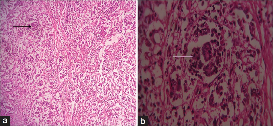 Hematoxylin and eosin stained tissue (a) at ×10 and (b) at ×40 show glandular formation (arrow) amounting to >30% of the tumor.