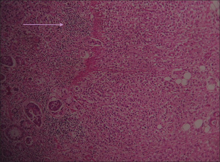 Hematoxylin and eosin stained tissue at ×10 shows tumor cells surrounded by focal lymphocyte response.