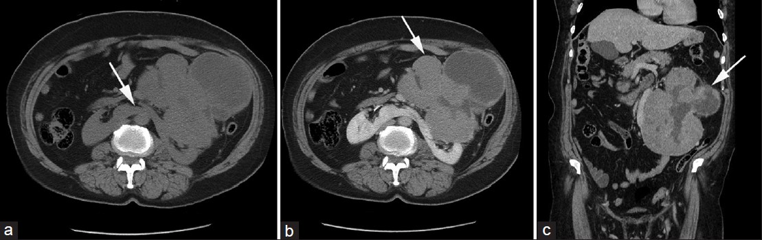 (a-c) CT scan images of the abdomen obtained at the level of inferior mesenteric artery. (a) Before administration of the contrast material shows a horseshoe kidney anomaly (arrow). Post-contrast images in b) axial and c) coronal planes show a large mass arising from the left part of the horseshoe kidney (arrow). The mass is multi-lobulated and heterogeneous in attenuation with a central area of cystic necrosis