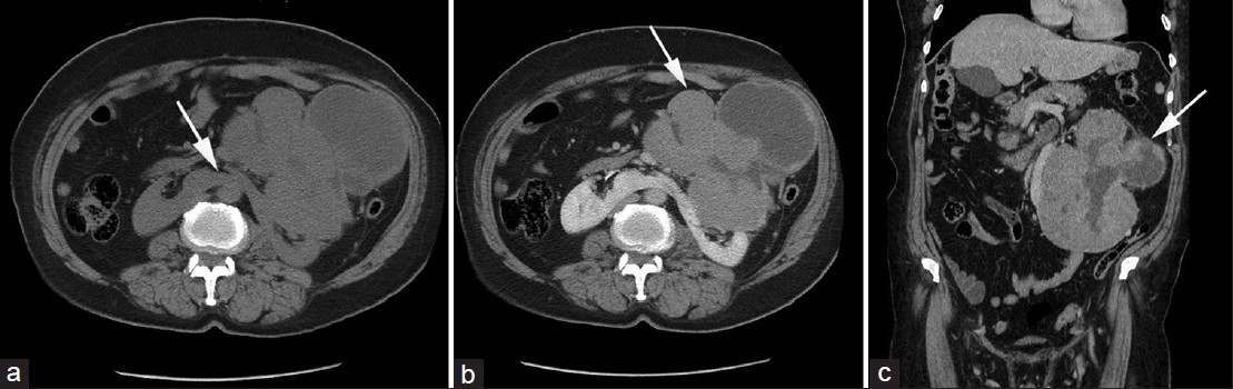 Horseshoe kidney, Radiology Reference Article